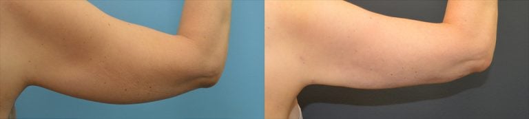 49-year-old, BodyTite and liposuction to arms, right arm, back, 5 months