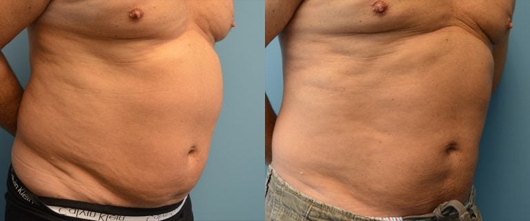 Male BodyTite and liposuction of abdomen right oblique