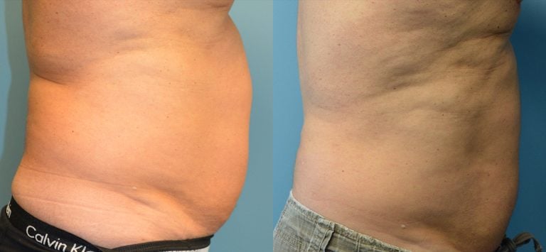 Male BodyTite and liposuction of abdomen side