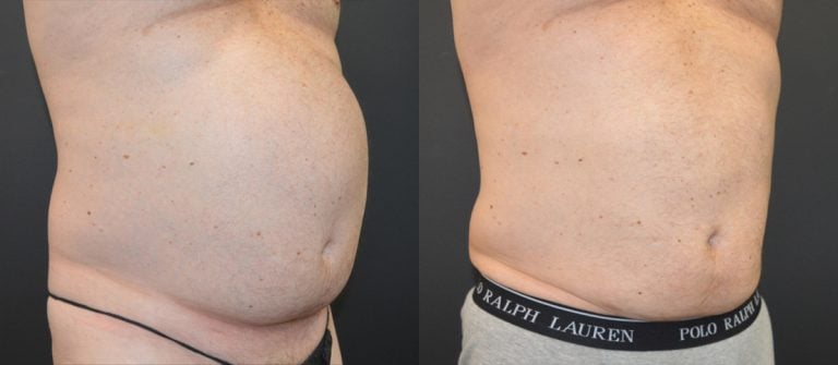 52-year-old, 7 weeks after liposuction and BodyTite abdomen and iliac crests with 19 pound weight loss oblique front view