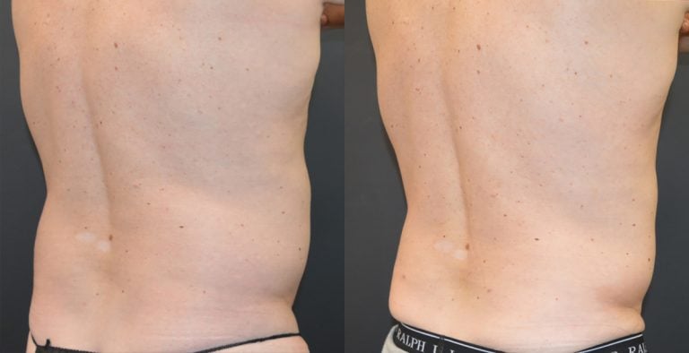 52-year-old, 7 weeks after liposuction and BodyTite abdomen and iliac crests with 19 pound weight loss oblique posterior view