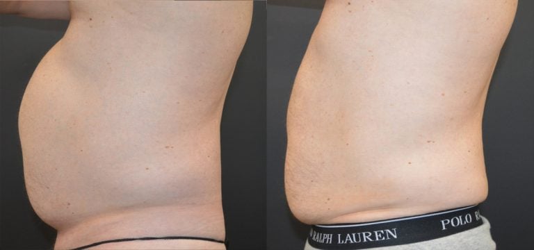 52-year-old, 7 weeks after liposuction and BodyTite abdomen and iliac crests with 19 pound weight loss, side view