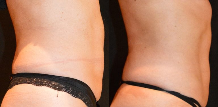 53-year-old BodyTite & liposuction abdomen and iliac crests side 1 view