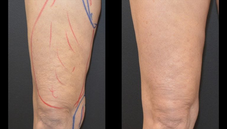 64-year-old 7 months after BodyTite & Morpheus anterior thighs and Lipo knees right leg