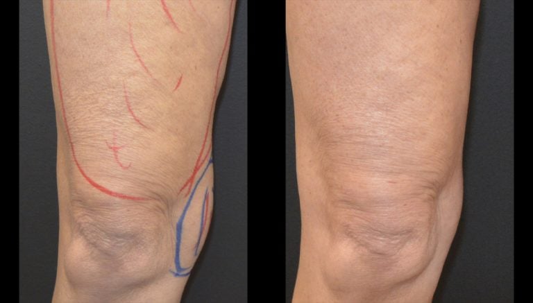 64-year-old 7 months after bodyTite and morpheus and Lipo knee right leg 7 months