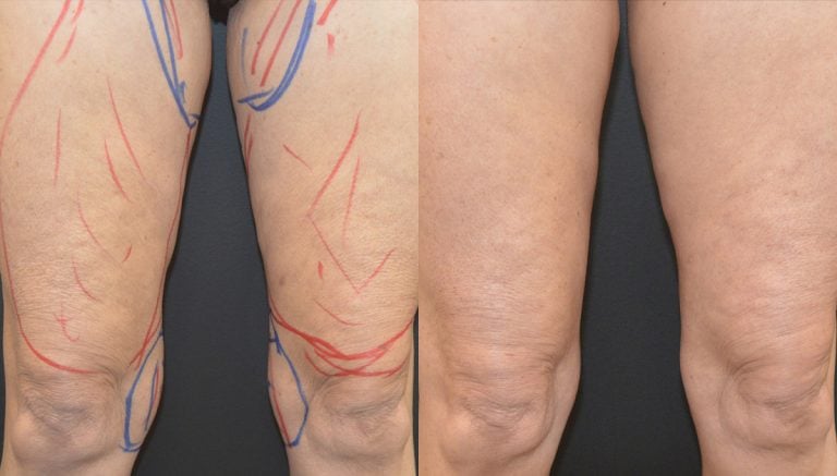 64-year-old 7 months after bodyTite and morpheus anterior thighs & Lipo knees left and right