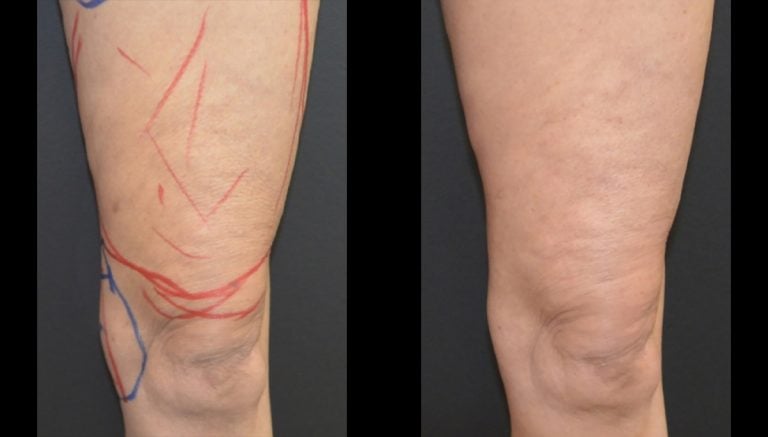 64-year-old, 7 months after BodyTite and Morpheus front of thigh, Lipo knee left leg