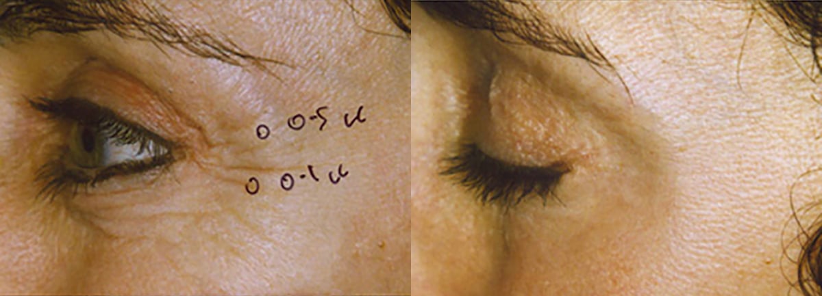 Botox crows feet - 1