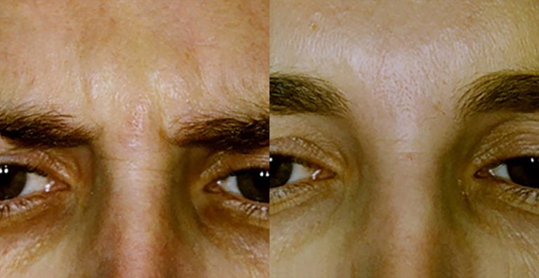 Botox glabella - 2