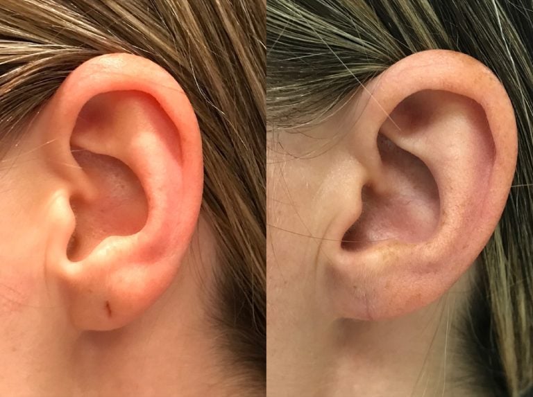 Earlobe repair - Case 1
