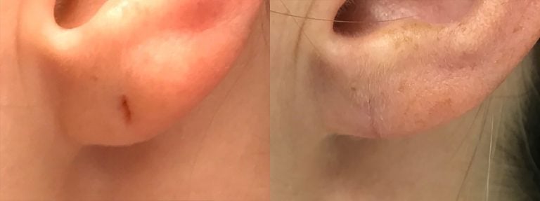 Earlobe repair left - 1
