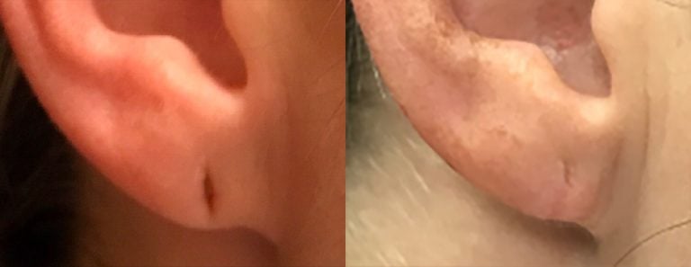 earlobe repair right - 1