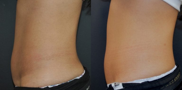 33-year-old, 6 EmSculpt NEO treatments abdomen, 3 months