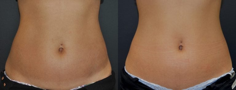 33-year-old, 6 EmSculpt NEO treatments abdomen, 3 months front