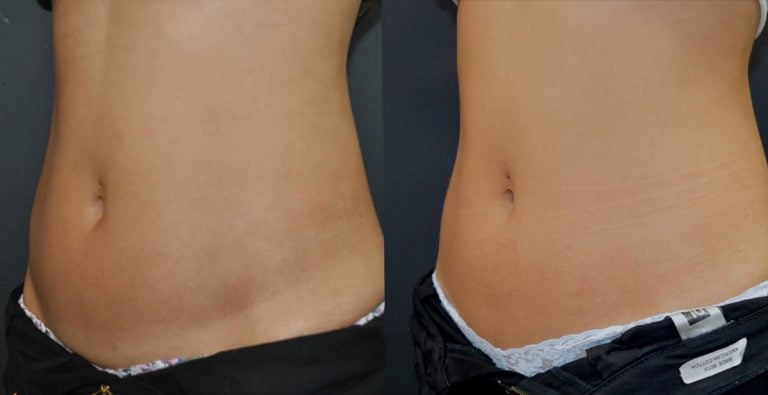 33-year-old, 6 EmSculpt NEO treatments abdomen, 3 months oblique