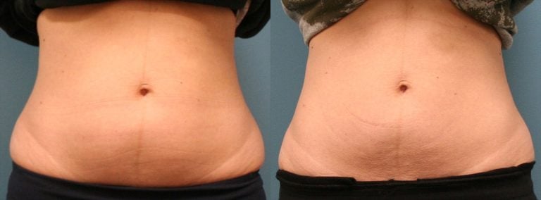 Emsculpt Neo 8 months after childbirth front