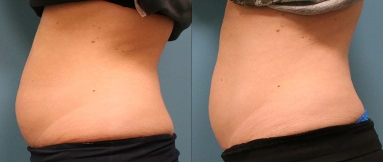 Emsculpt Neo 8 months after childbirth left side