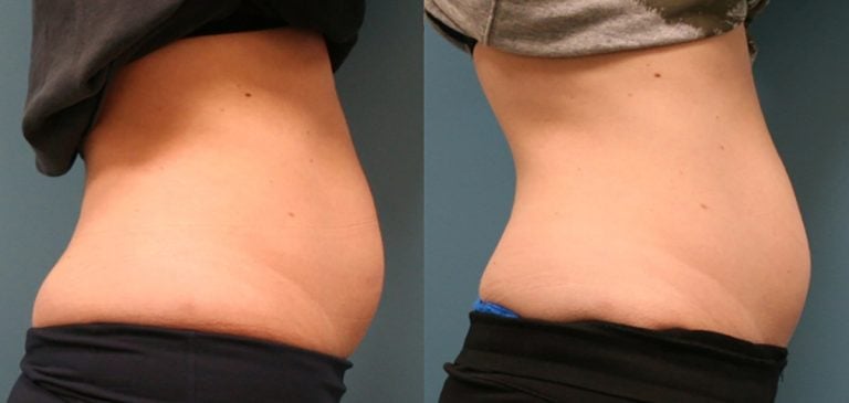Emsculpt Neo 8 months after childbirth right side