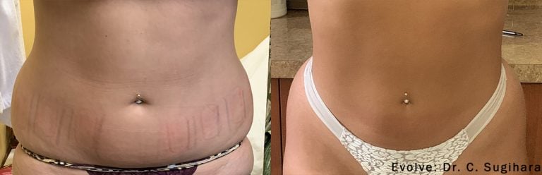 Evolve Abdomen - 1