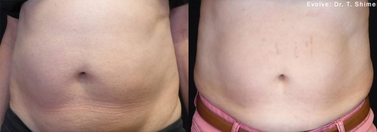 Evolve Abdomen - case 11