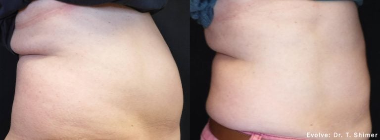 Evolve Abdomen - 11