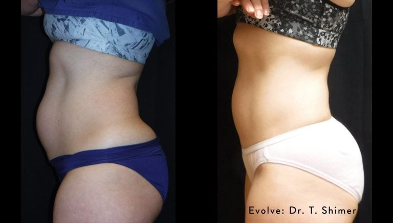 Evolve trim abdomen - 12