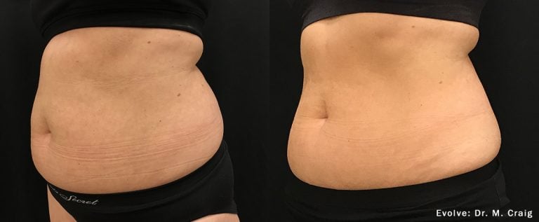 Evolve Abdomen - Case 13