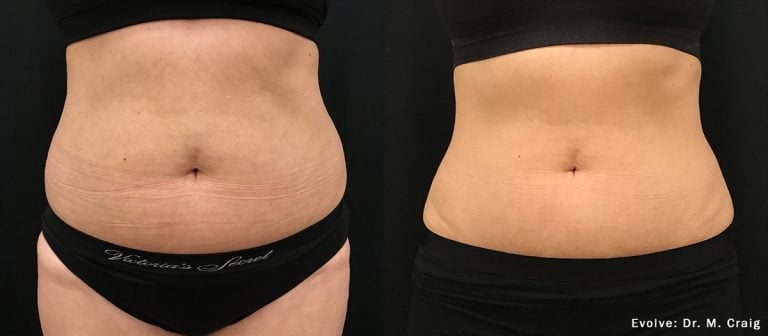Evolve Abdomen - 13