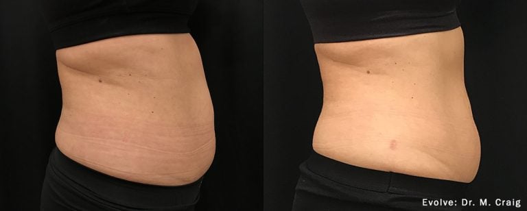 Evolve Abdomen - Image 13