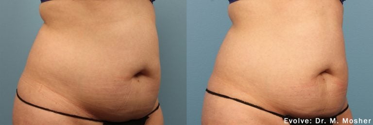 Evolve Abdomen - 14