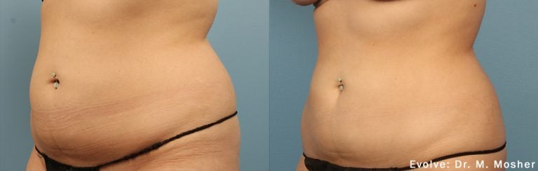 Evolve Abdomen - 15