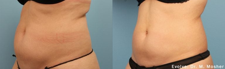 Evolve Abdomen - Case 16