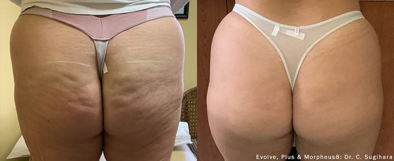 Evolve cellulite scaled - 2