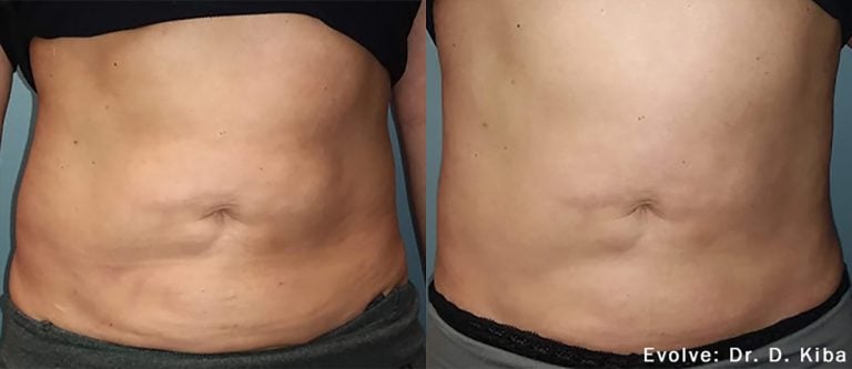 Evolve Abdomen - 3
