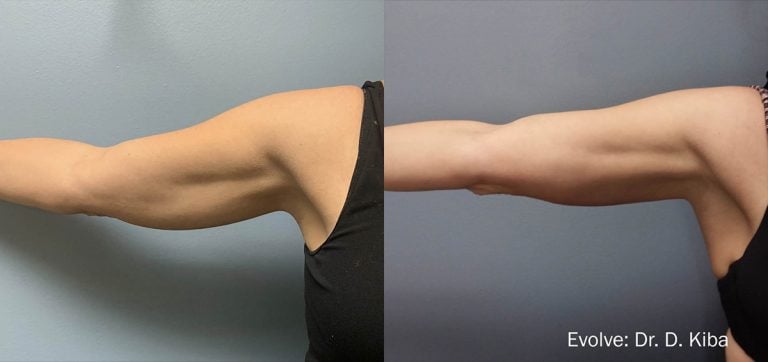 Evolve arms scaled - 4