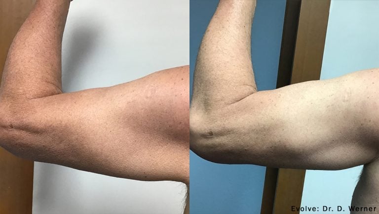 Evolve arms - 5