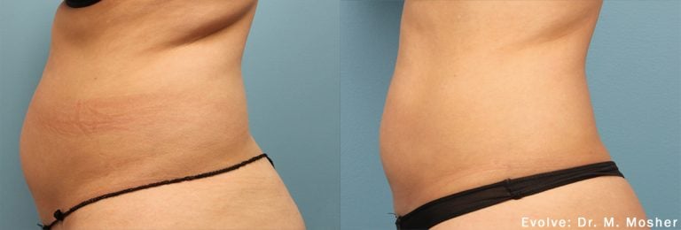 Evolve Abdomen - 7