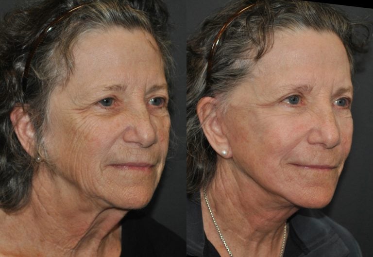 78-year-old 40% Facelift, submental platysmaplasty, upper eyelid blepharoplasty TCA perioral & lower eyelid peel 12 weeks after surgery, oblique