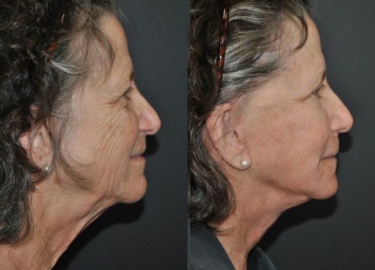 78-year-old 40% Facelift, submental platysmaplasty, upper eyelid blepharoplasty TCA perioral & lower eyelid peel 12 weeks after surgery, side