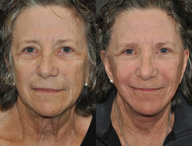 78-year-old 40% Facelift, submental platysmaplasty, upper eyelid blepharoplasty TCA perioral & lower eyelid peel 12 weeks after surgery