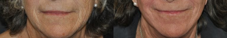 78-year-old 40% TCA perioral peel 12 weeks after surgery