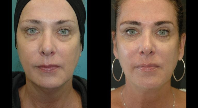 Facetite & morpheus 5 months front