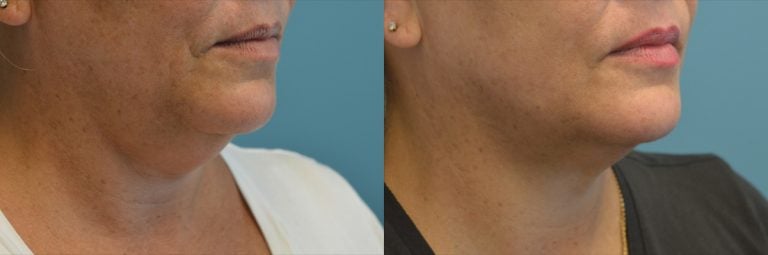 Faceitite liposuction and morpheus of neck and jowls one month after oblique view