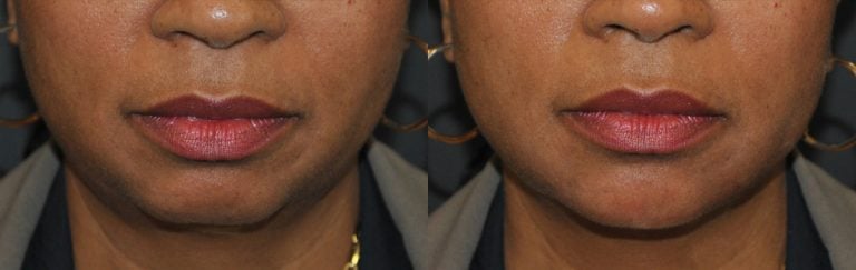 VOLUX jaw line and chin front