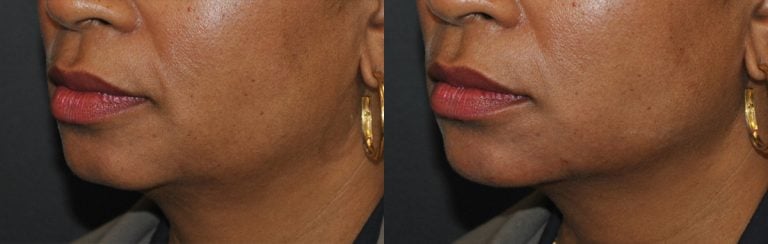 VOLUX jaw line left oblique