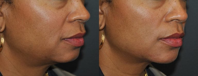 VOLUX jaw line right oblique