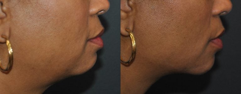 VOLUX jaw line right side