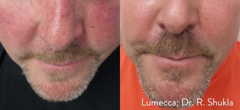 Lumecca Frontal - scaled