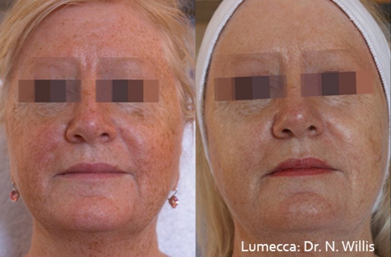 Lumecca 1a 4weeks apart
