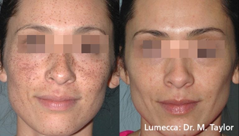 Lumecca 1b 580nm ShortPulse